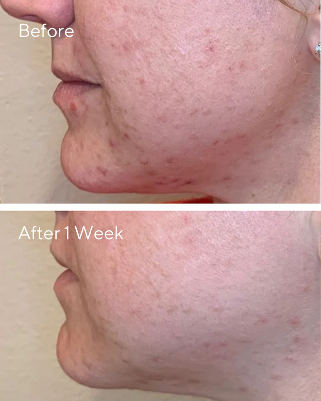 AHA/BHA/Retinoid Daily Clarifying Peel - Image 4